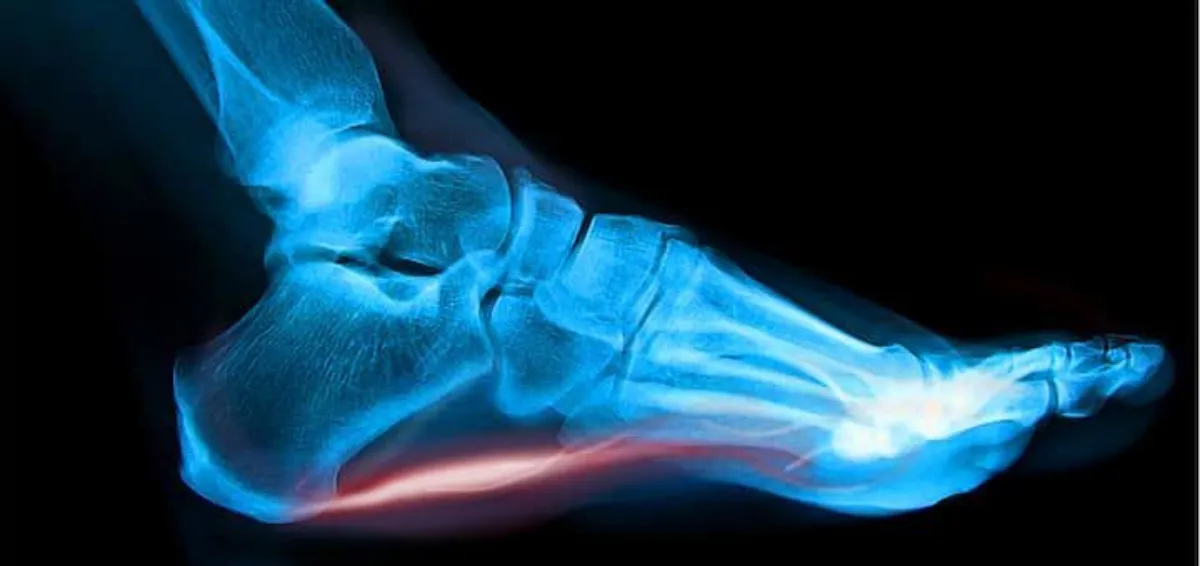 Plantar Fasciitis 01