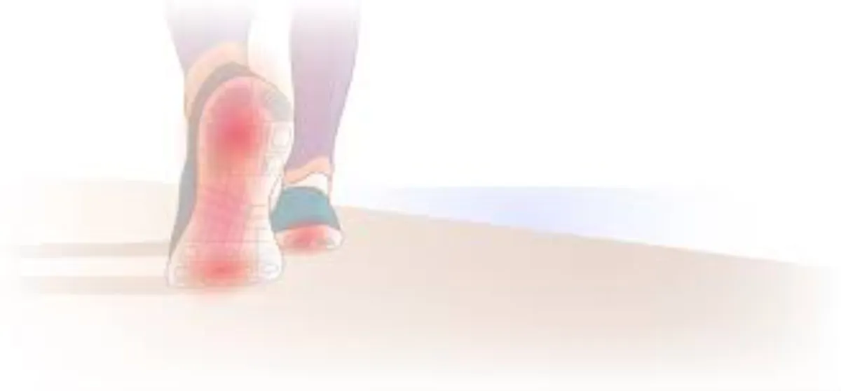 Plantar Fasciitis 05