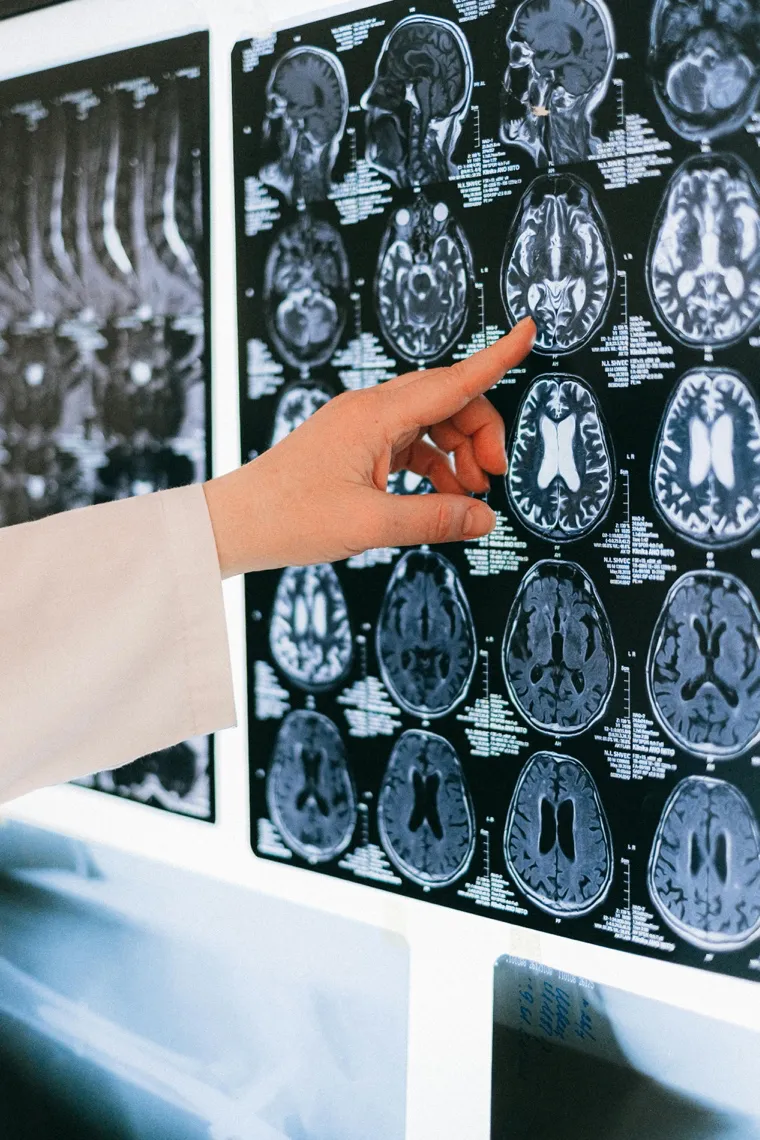 Rehabilitation For Functional Neurological Disorder 01